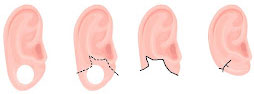 Split Earlobe